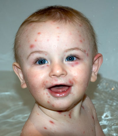 Childhood rashes, skin conditions and infections: photos ...
