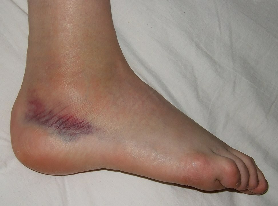 How long does a broken ankle take to heal?