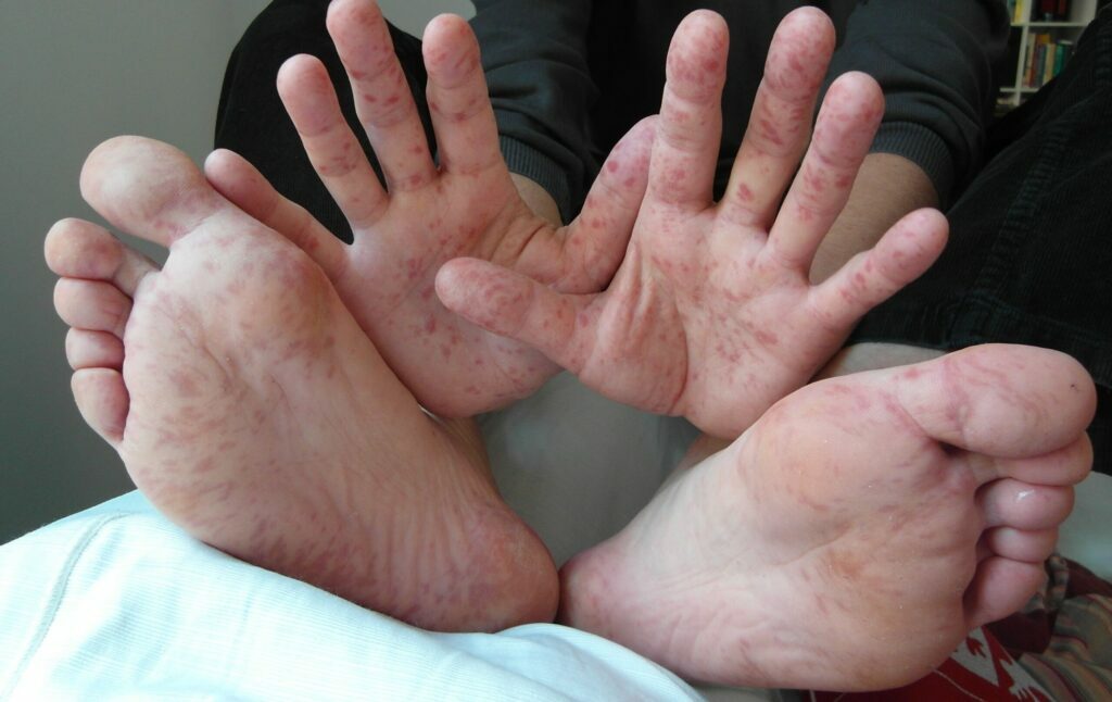 hand-foot-and-mout-disease